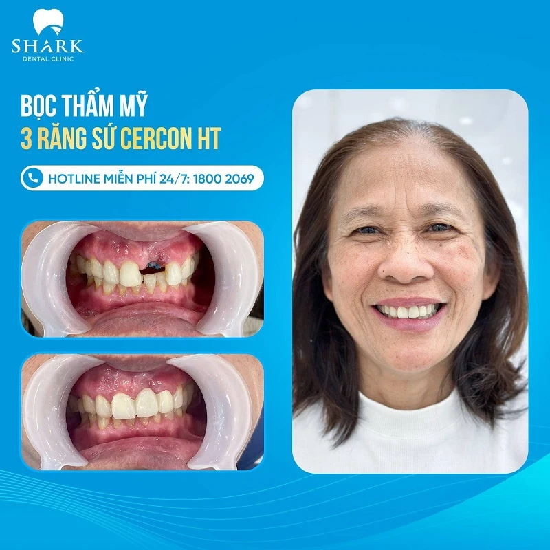 So sánh sứ kim loại và toàn sứ, nên chọn loại nào phù hợp? 10 Khách hàng bọc răng không loại Cercon HT ở Shark