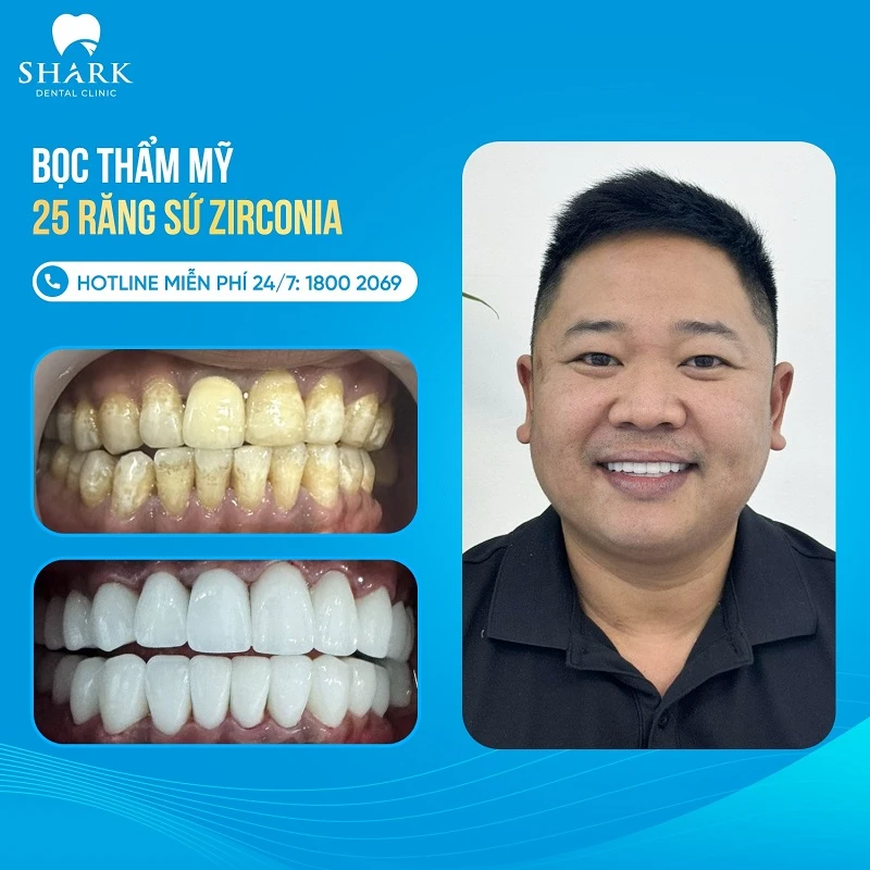 So sánh sứ kim loại và toàn sứ, nên chọn loại nào phù hợp? 11 Khách hàng chọn sứ Zirconia tại Shark