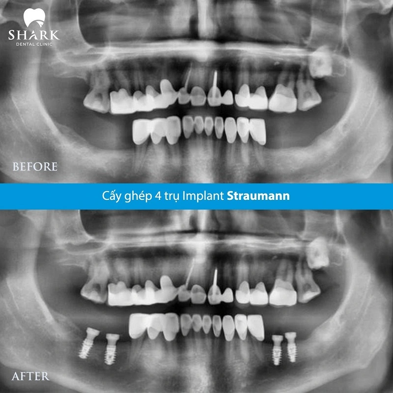 Khách hàng cấy Implant Straumann bởi bác sĩ Được tại Nha khoa Shark
