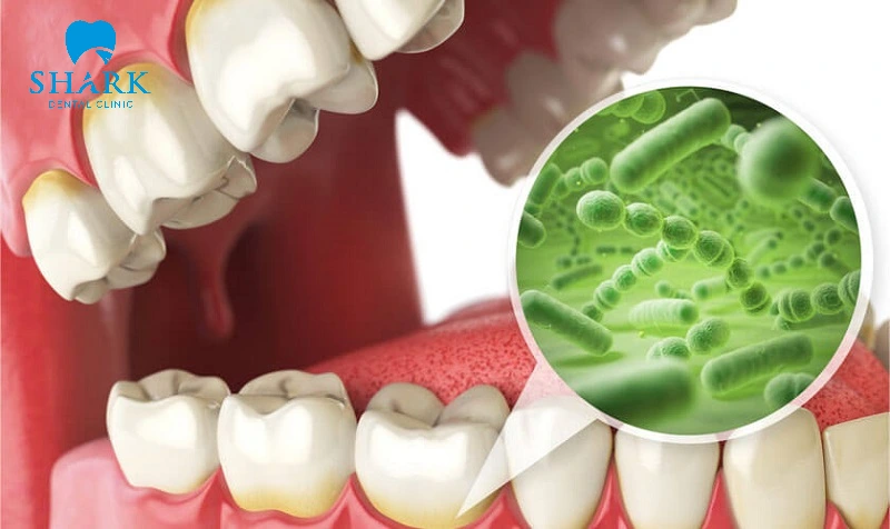 Các rủi ro nguy hiểm khi không thay răng sứ bị hư kịp thời