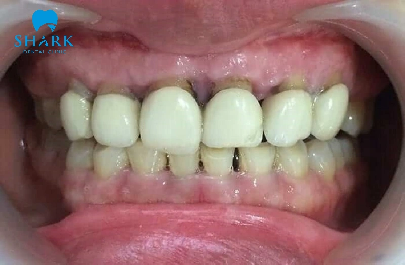 Dấu hiệu nhận biết cần thay răng sứ bị hư hỏng