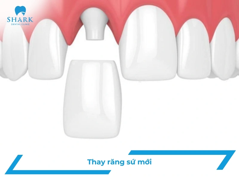 Thay thế răng sứ mới
