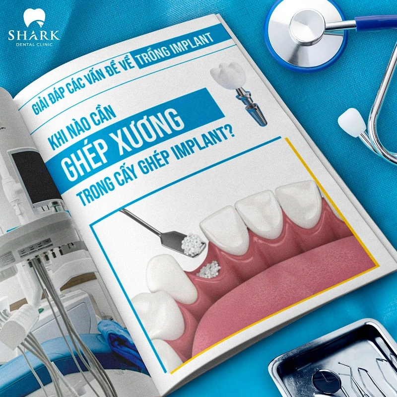 Tiểu đường tuýp 2 có trồng răng Implant được không? 16 Ghép xương cho người tiểu đường và loãng xương
