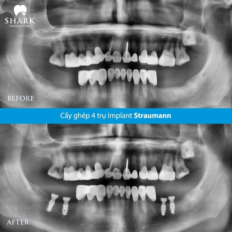 Tiểu đường tuýp 2 có trồng răng Implant được không? 14 Hình ảnh/Video X-quang và Before-After cận cảnh nướu lành thương của chú Cường sau 1 tuần và hình ảnh nụ cười hoàn thiện sau phục hình răng sứ