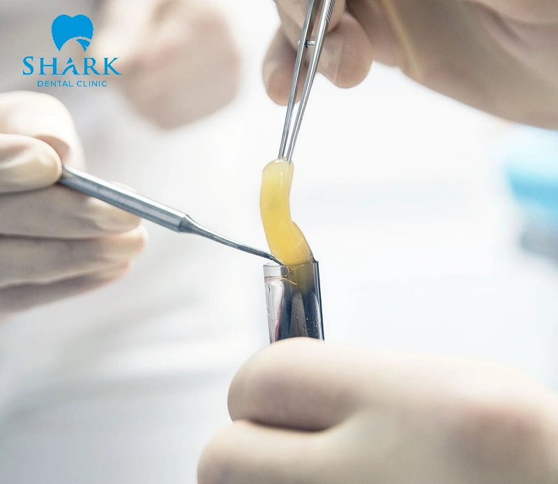 Tiểu đường tuýp 2 có trồng răng Implant được không? 13 PRF rút ngắn thời gian cấy ghép răng