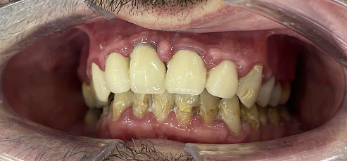 Tim Lafser trước khi điều trị
