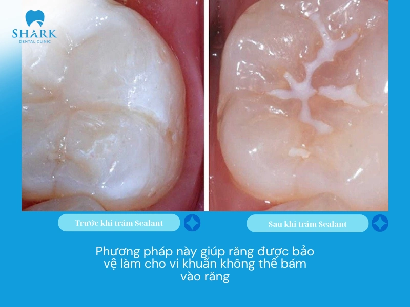Phương pháp này giúp phòng ngừa và ngăn chặn vi khuẩn bám vào răng