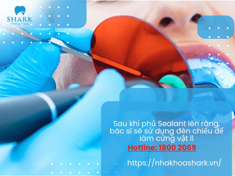 Sau khi phủ lớp Sealant lên răng, bác sĩ sẽ sử dụng đèn chiếu làm cứng vật liệu