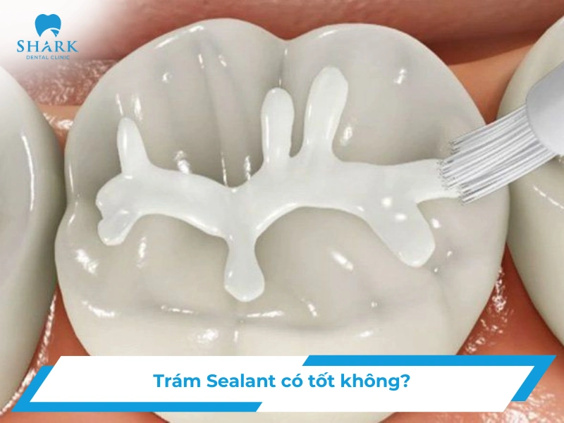 trám sealant có tốt không