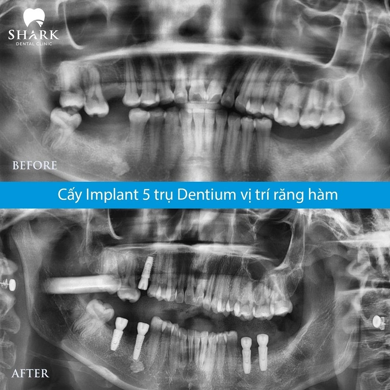 Chị Tuyết cấy 5 trụ Implant Denitum cho răng cấm tại Nha khoa Shark