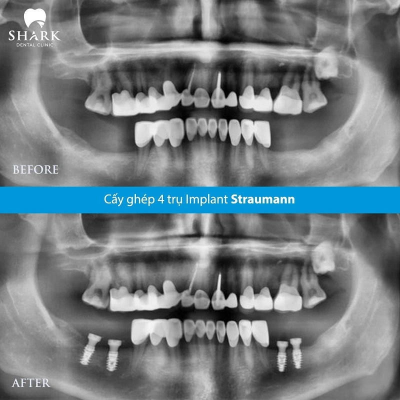 X-quang của anh Hùng trồng 4 trụ Implant Straumann thành công