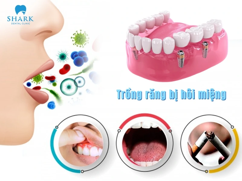 Sau khi trồng răng Implant có bị hôi miệng không? 12 Trồng răng Implant bản chất không gây hôi miệng