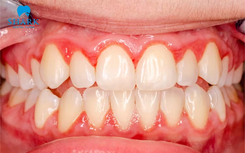Sau khi trồng răng Implant có bị hôi miệng không? 15 Viêm nhiễm răng miệng chưa điều trị dứt điểm trước khi trồng Implant