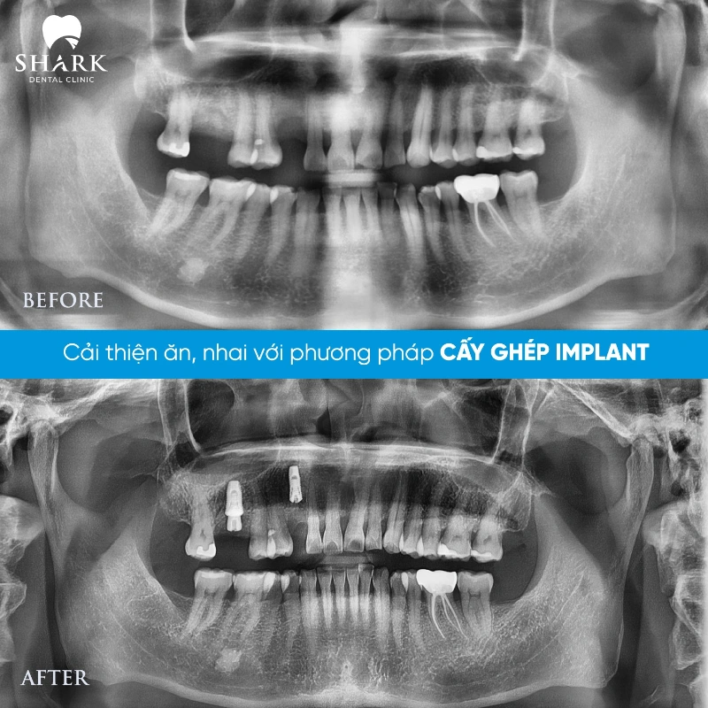 Sau khi trồng răng Implant có bị hôi miệng không? 20 X-quang chú Minh trồng răng ở Nha khoa Shark