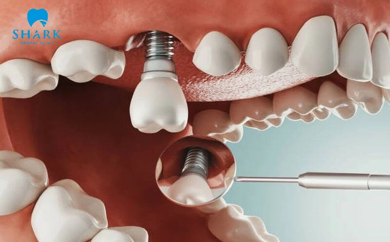 Sau khi trồng răng Implant có bị hôi miệng không? 18 Vật liệu trồng răng không rõ nguồn gốc dễ để lại biến chứng và gây hôi miệng