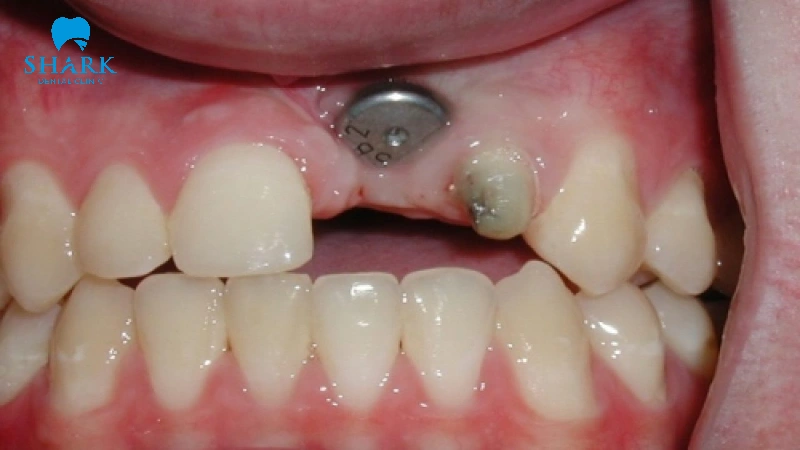 Sau khi trồng răng Implant có bị hôi miệng không? 17 Kỹ thuật phục hình trụ Implant sai cách gây hôi miệng