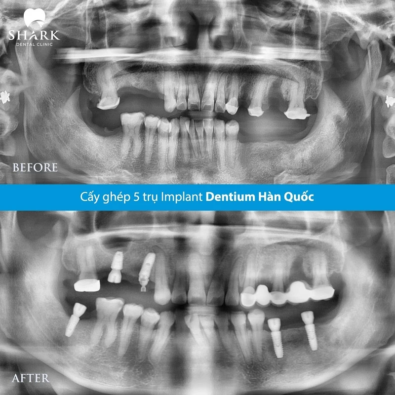 X-quang răng của chú Lộc sau khi trồng 3 trụ răng ở vị trí răng hàm