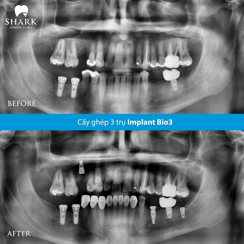 X-quang răng của chị Hoa khi trồng răng số 7 bằng Implant Bio3