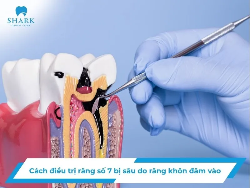 Cách điều trị răng số 7 bị sâu do răng khôn đâm vào hiệu quả