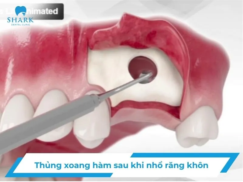 Thủng xoang hàm sau khi nhổ răng khôn có nguy hiểm không? 9 Thủng xoang hàm sau khi nhổ răng khôn có nguy hiểm không?