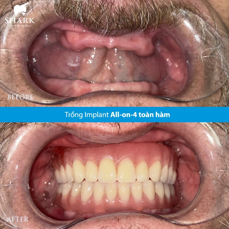 Trồng răng bắt vít là gì? Giá bắt vít Implant là bao nhiêu? 6 X-quang của chú Hoàng