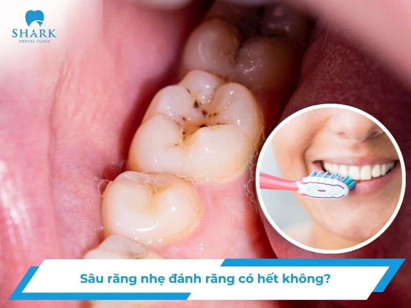 Sâu răng nhẹ đánh răng có hết không