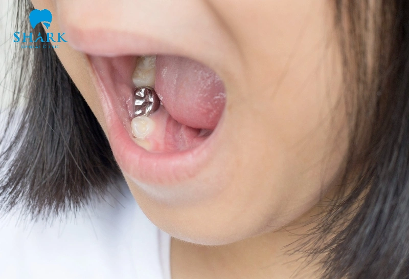 Bọc răng bạc cho răng hàm