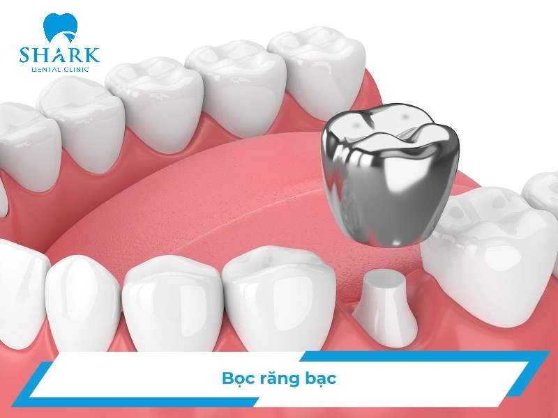 Bọc răng bạc