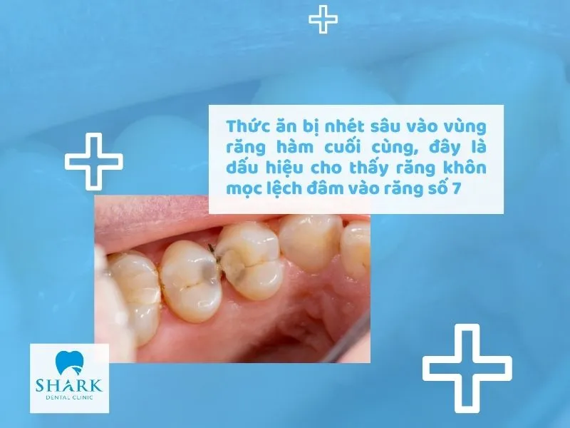Thức ăn bị nhét sâu vào vùng răng hàm cuối cùng, đây là dấu hiệu cho thấy răng khôn mọc lệch đâm vào răng số 7