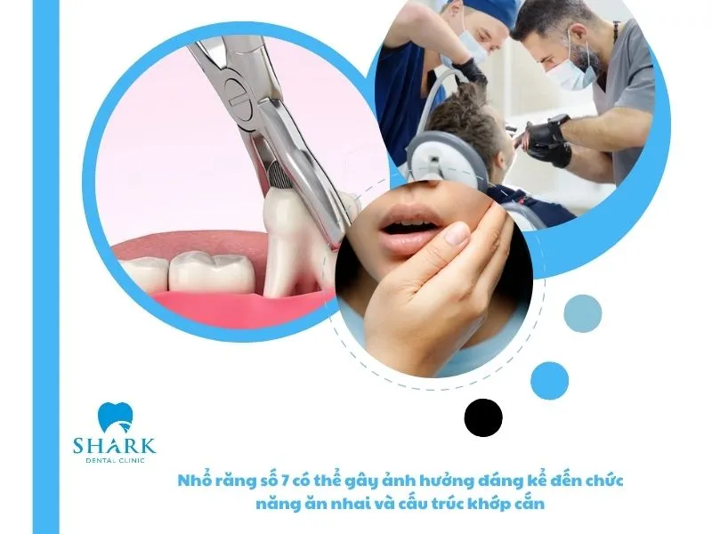 Nhổ răng số 7 có thể gây ảnh hưởng đáng kể đến chức năng ăn nhai và cấu trúc khớp cắn