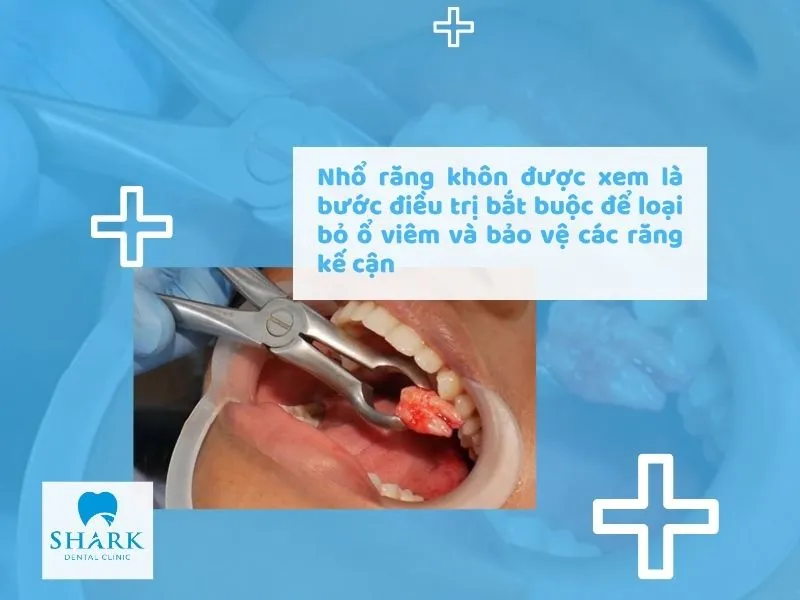 Nhổ răng khôn được xem là bước điều trị bắt buộc để loại bỏ ổ viêm và bảo vệ các răng kế cận