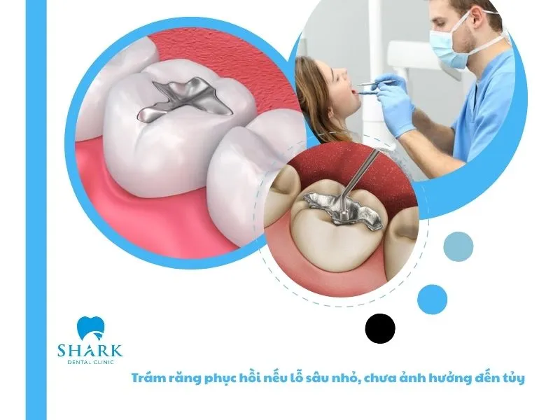 Trám răng phục hồi nếu lỗ sâu nhỏ, chưa ảnh hưởng đến tủy