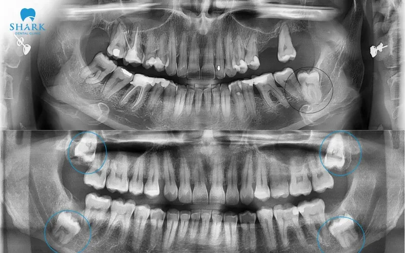 Anh Minh được bác sĩ chụp phim CT để xác định chính xác vị trí mọc của răng khôn