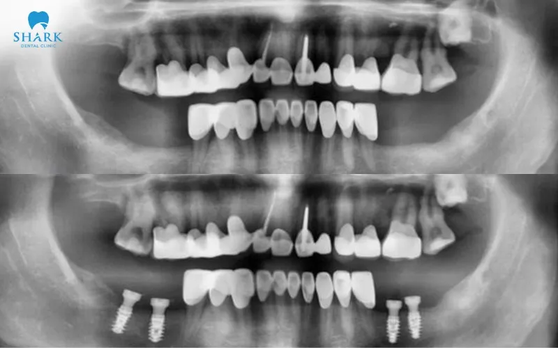 Anh Minh được chỉ định thực hiện cấy ghép Implant sau khi nhổ răng nhằm đảm bảo tối đa khả năng ăn nhai