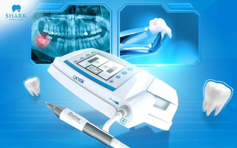 Nha khoa Shark sử dụng công nghệ sóng siêu âm Piezotome để nhổ răng nhằm mang lại cảm giác thoải mái cho anh Minh trong suốt quá trình thực hiện