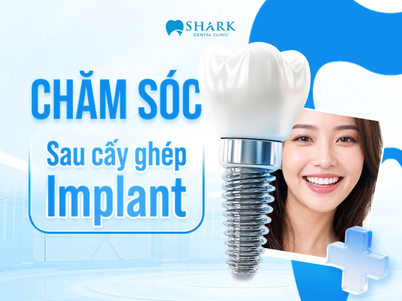 Hướng dẫn chăm sóc sau cấy ghép Implant