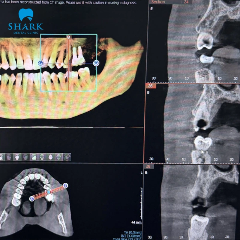 Đánh giá tình trạng tiêu xương trước khi cấy ghép implant zygoma