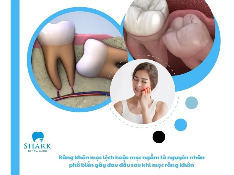Răng khôn mọc lệch hoặc mọc ngầm là nguyên nhân phổ biến gây đau đầu sau khi mọc răng khôn