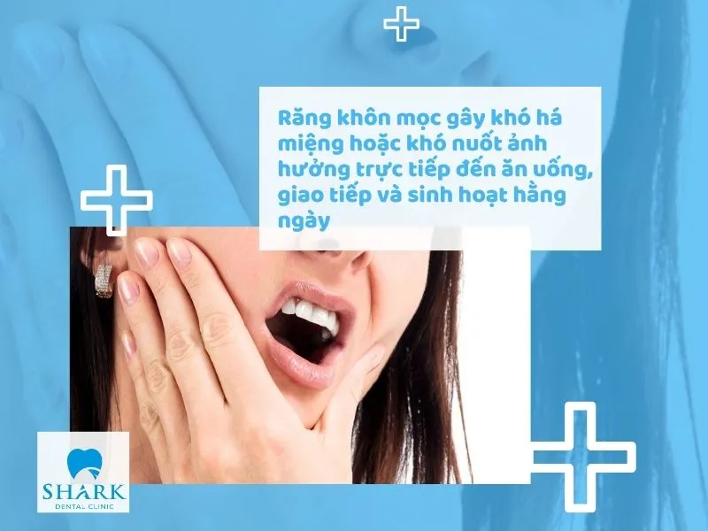 Răng khôn mọc gây khó há miệng hoặc khó nuốt ảnh hưởng trực tiếp đến ăn uống, giao tiếp và sinh hoạt hằng ngày.