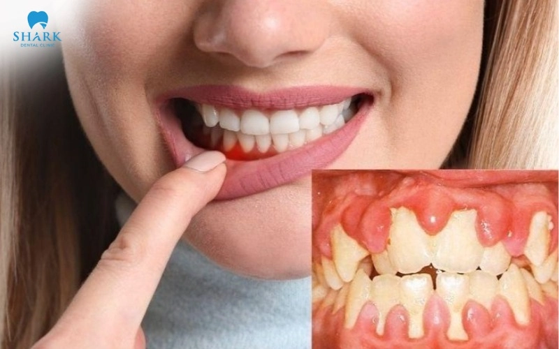 Để đảm bảo vết thương sau điều trị nhanh hồi phục, bạn nên tuân thủ những hướng dẫn chăm sóc để giảm khó chịu và hạn chế viêm nướu tái phát