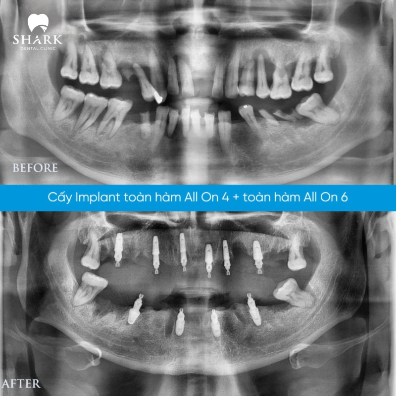 Cấy ghép Implant All on 6 là gì? Giá tiền trồng Implant 6s 7 Cấy All on 4 và All on 6 cho chú Hùng