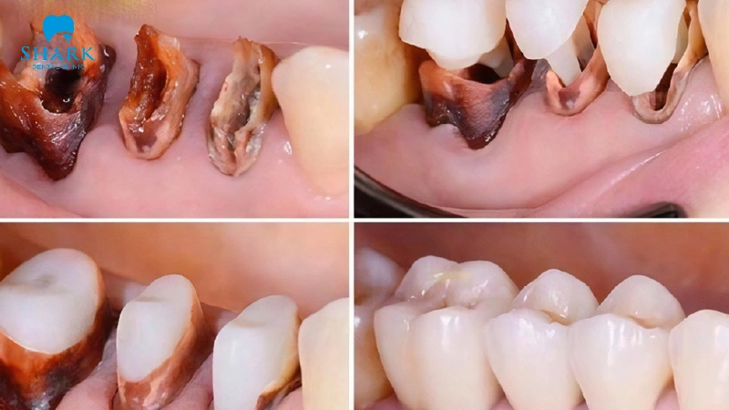 Mòn răng sứ gây ra hậu quả gì