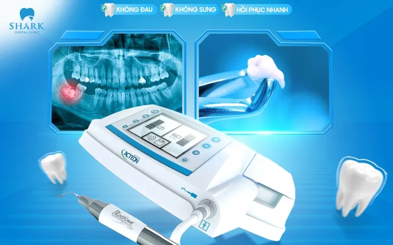 Răng khôn có mấy chân? Các kiểu chân răng thường gặp nhất 8 Nhổ răng khôn bằng máy sóng siêu âm
