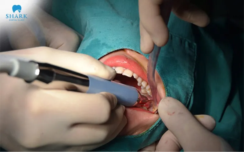 Nhổ răng khôn bằng máy sử dụng sóng siêu âm cao tần để tác động và tách răng ra khỏi xương hàm một cách nhẹ nhàng