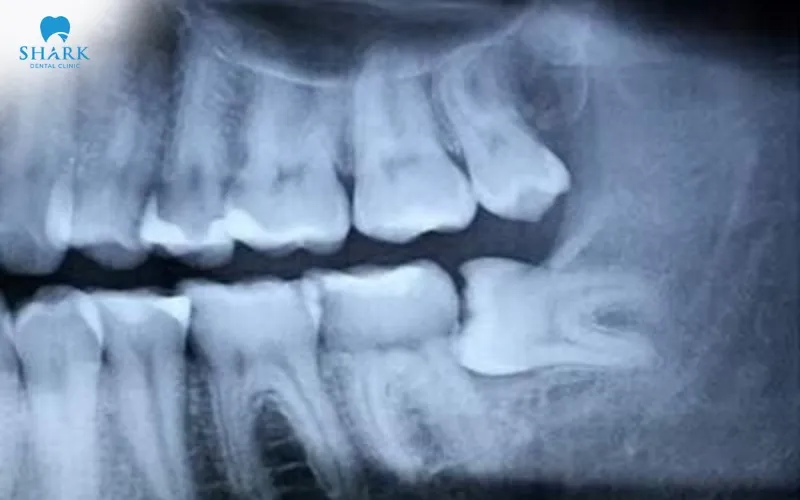 Nhổ răng khôn bằng máy thường được chỉ định thực hiện cho những trường hợp răng khôn mọc lệch, mọc ngầm hoặc mọc ngang dưới nướu