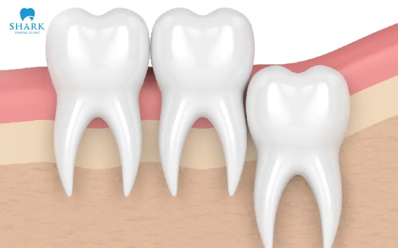 Với những chiếc răng khôn mọc thẳng, trồi lên rõ ràng có thể thực hiện nhổ răng khôn truyền thống