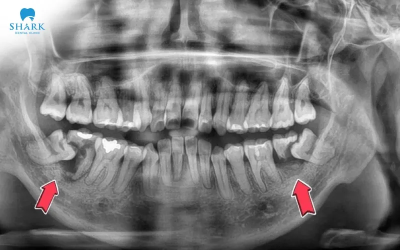 Kết quả chụp X-quang cho thấy anh Nam có hai chiếc răng khôn mọc lệch ngầm phức tạp, nằm sát ống dây thần kinh hàm dưới
