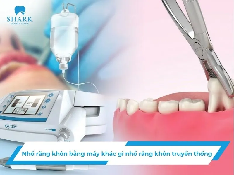 Nhổ răng khôn bằng máy khác gì nhổ răng khôn truyền thống