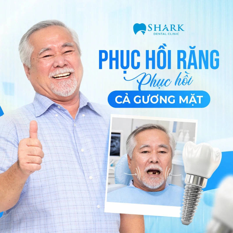 Cấy ghép Implant All on 6 là gì? Giá tiền trồng Implant 6s 8 Kết quả thẩm mỹ trồng răng implant all on 6 tại Nha khoa Shark