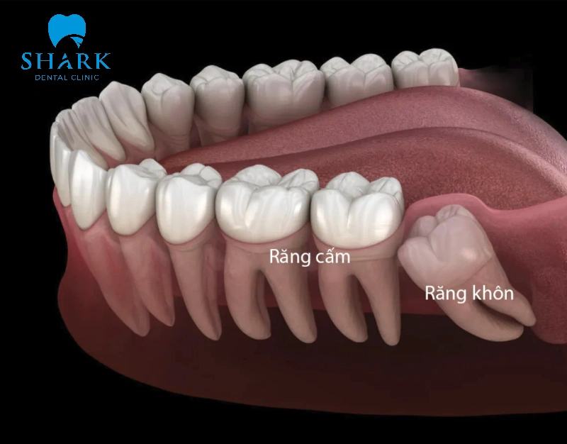 Răng 6,7 gọi là răng cấm còn răng số 8 gọi là răng khôn